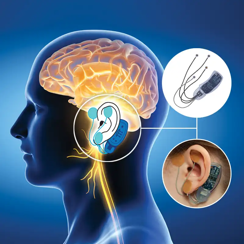 IB-Stim® for Functional Abdominal Pain